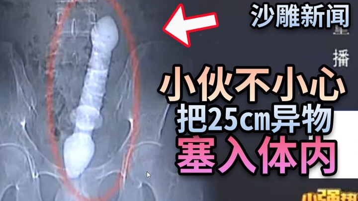 Young man accidentally inserts a 25-centimeter foreign object into his body and can’t remove it, so 