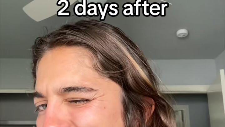 Comparison before and after Botox