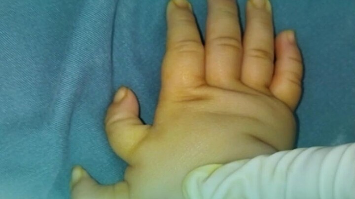 One thumb keeps its function, the other looks better—never just cut one off without good reason.