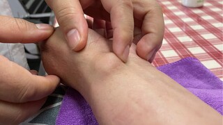 Ganglion cyst instant kill