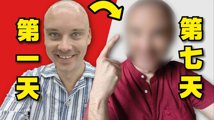 Let's take a look at how foreigners look after hair transplants in China... It even made me cry!!