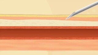 Are IV punctures always failing? Learn the reasons in just 1 minute!