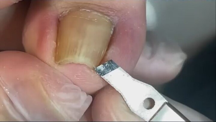 Pedicure Tutorial  Ingrown toenail Drills into toe meat and cause pain_R