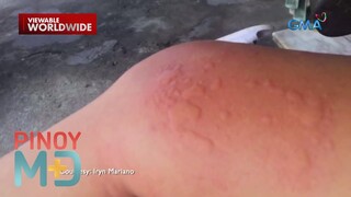 Ano ang sakit na ‘urticaria’? | Pinoy MD