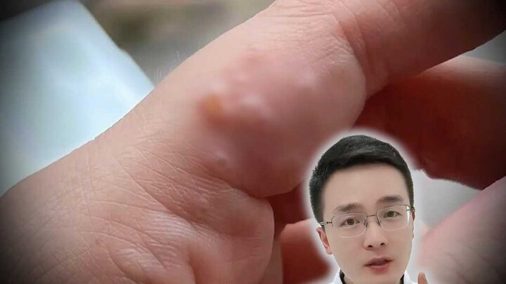 Saat pergantian musim semi ke musim panas, muncul gelembung kecil bening seukuran butir beras di tan