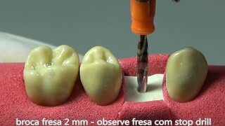 Simulating the entire dental implant process... It turns out you have to undergo three minor surgeri