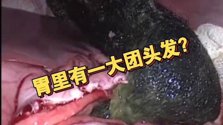 فتاة مصابة باضطراب الأكل غير الطبيعي تأكل شعرها باستمرار.. شاهد كيف تُستخرج من جسدها خلال الجراحة!