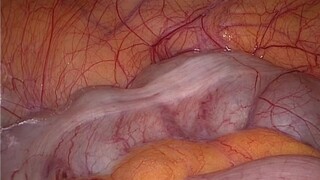 هل تستطيع تحمّل تجربة استخدام منظار البطن لاستكشاف أعضاء البطن؟ (الجزء الثاني)
