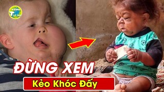 10 Đứa Trẻ Có Ngoại Hình Kỳ Lạ Và Đáng Thương Nhất Khiến Hàng Triệu Người Rơi Nước Mắt