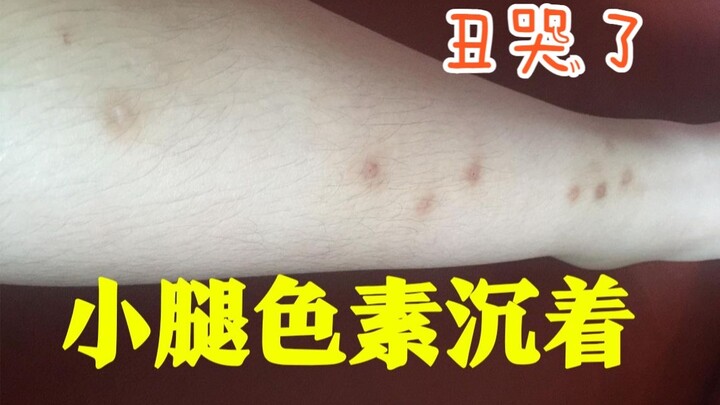 A Few Tricks to Tackle Post-Eczema and Insect Bite Hyperpigmentation