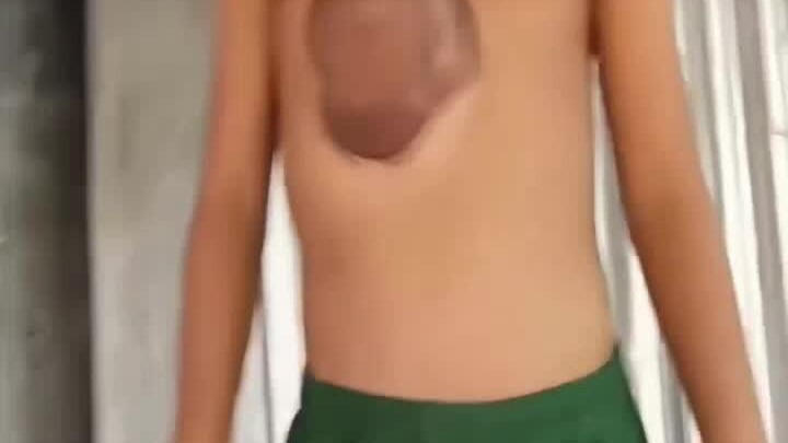 A child with a heart growing outside the body