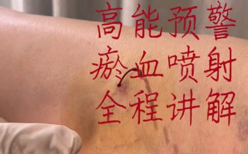 Record-breaking!!! Is everyone on edge with this length? Blood stasis erupts—full commentary through