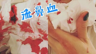 HyunA đăng ảnh trên Instagram bị chảy máu mũi! Chị quá vất vả rồi! Hãy chú ý sức khỏe nhé Kim Hyun A