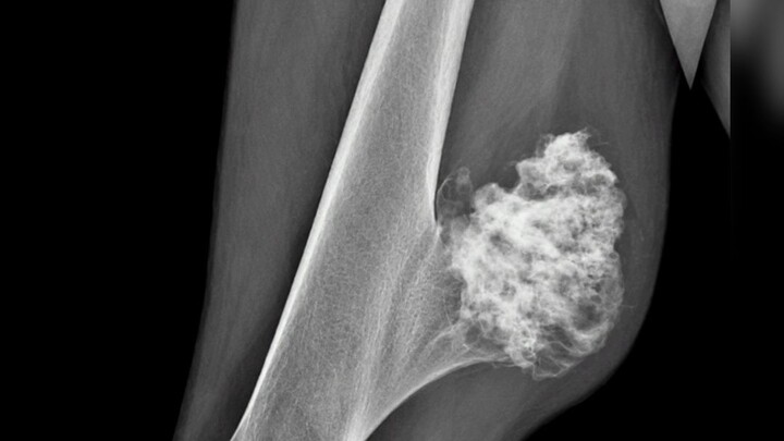 Why Does Bone Grow Like a Cauliflower on the Back of the Femur? Osteochondroma (Exostosis): Causes,