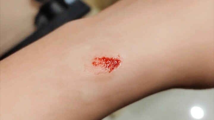 A textbook case of superficial dermal injury (so to speak, I’ve sacrificed myself for the sake of sc