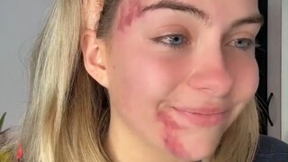 A young lady with a strange skin disease suddenly develops large red spots on her face