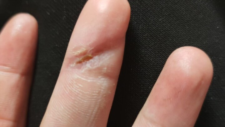 Self-Healing of Fingers