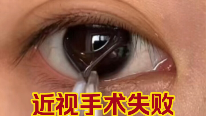 Trải nghiệm phẫu thuật LASIK nửa bước của tôi thất bại