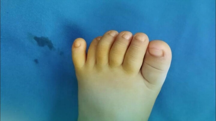 พ่อฝ่าเสียงคัดค้านผ่าตัดเอาหัวแม่เท้าที่เกินออก แม่ว่า: รอยแผลเป็นแทบมองไม่เห็นแล้ว!