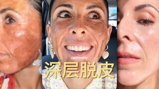 Cara baru untuk kecantikan: Pengelupasan kulit‼️