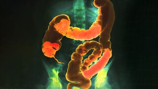 This guy ate 20 protein bars a day for 6 weeks, and this is what happened to his colon