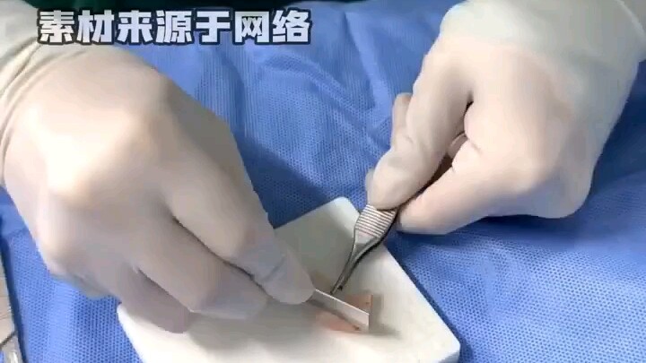 Lấy chính xương sườn của mình để nâng mũi, bỗng thấy mình trông đẹp hơn một chút
