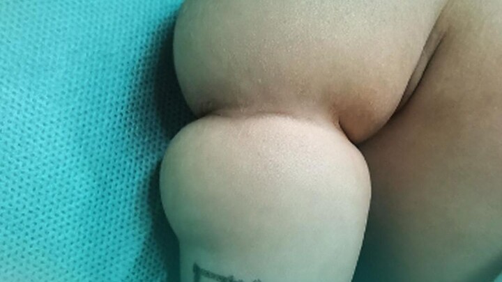 แขนของทารกถูกรัดด้วยเชือกเป็นวงรอบ แพทย์จึงผ่าตัดเพื่อคลาย "เชือก" นั้น