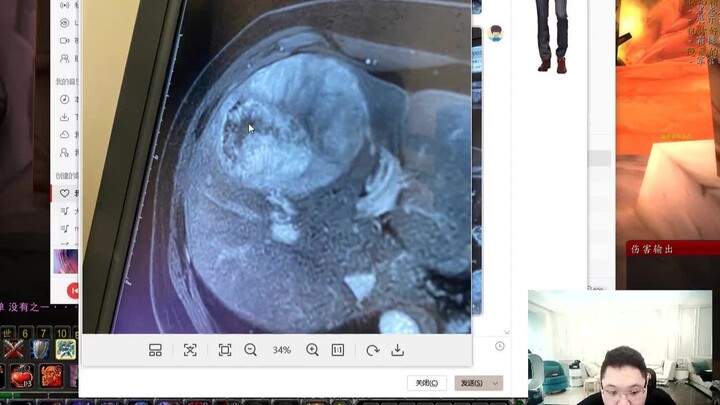 ความคืบหน้าล่าสุดเกี่ยวกับเนื้องอกตับของพีดีดี: ความซับซ้อนติดอันดับท็อป 10 ของโรงพยาบาลจงซานประจำปี