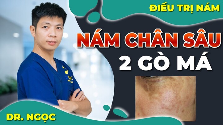 Cách trị nám chân sâu hai bên gò má  - Dr Ngọc