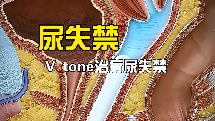 Domestic research indicates that the prevalence of stress urinary incontinence among adult women is 