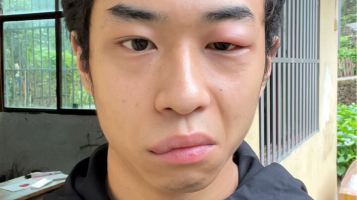 لدغتني البعوضة وتركَتْ لي حبتين، وظلوا يسخرون مني طوال اليوم.