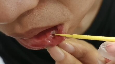 Challenge the fastest way to solve oral ulcers on the entire network~