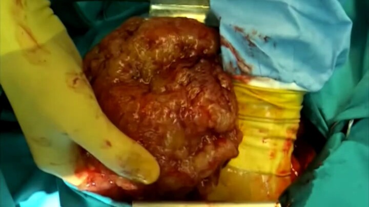 استئصال ورم قلبي يزن حوالي كيلوغرامين (فيديو جراحي، يُنصح بتوخي الحذر قبل المشاهدة)
