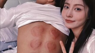 媳妇今天给我拔火罐，说实话技术还不赖！