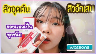 รีวิวPuricas ที่1จาก watsons รักษาสิวอุดตัน สิวอักเสบ รอยเเดง รอยดำ รอยยุงกัด เเผลเป็น | Ikziice