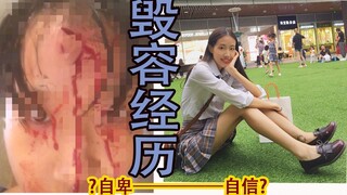 Disfiguring Experience | What Did I Go Through From Low Self-Esteem to Confidence? | How to Step Out