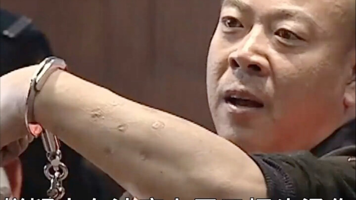 ผู้ต้องสงสัยโชว์รอยไหม้จากบุหรี่ต่อหน้าศาล