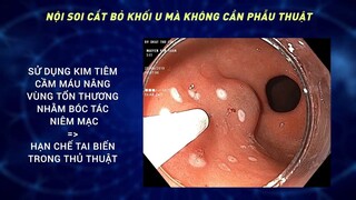 Cận cảnh quá trình nội soi cắt bỏ khối u mà không cần phẫu thuật