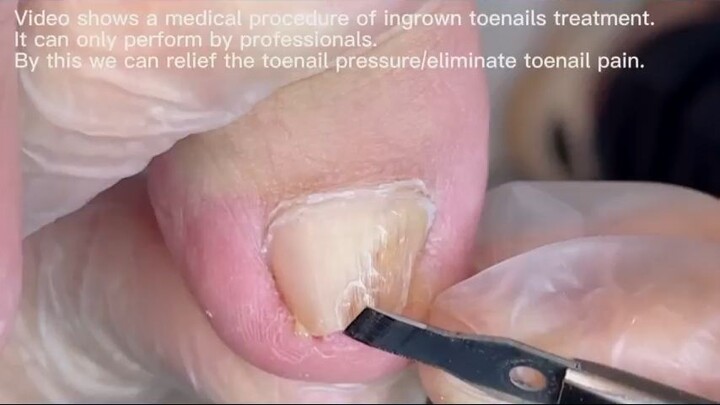 Onychomycosis makes the toenail become hollow_R
