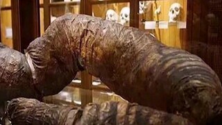 世界上最长时间不拉屎的人，三年未排便活活被屎憋死！