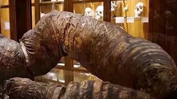 The person who went the longest without defecating in the world—three years without a bowel movement