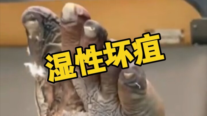 糖尿病患者足部湿性坏疽