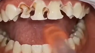 إذا كانت أسنانك على هذا الشكل، فلا تلجأ بسهولة إلى تركيب التيجان، فالإصلاح في مكانه الأصلي أكثر جمال