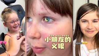 Trẻ em có mắt nhân tạo‼️💗