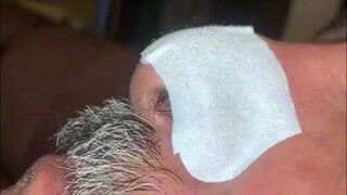 Blackheads in 1999