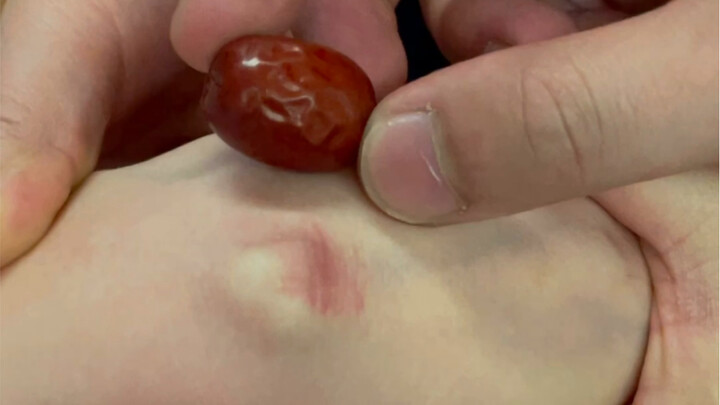 Đánh bay u nang bao gân trong tích tắc