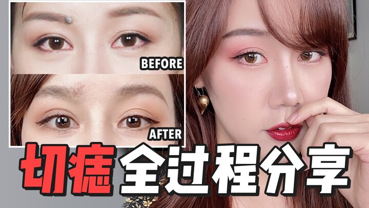 Nốt ruồi “phúc khí” mọc hơn chục năm nay đã được tôi phẫu thuật cắt bỏ! Chia sẻ toàn bộ hướng dẫn cắ