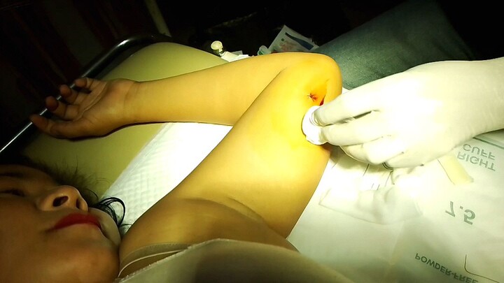 implant removal❤️