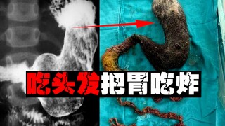 [Sindrom Rapunzel] Seorang gadis meninggal setelah tumpukan rambut seberat 1 kg meledak di perutnya.