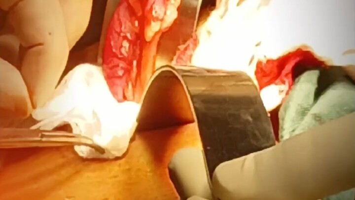 my first surgury